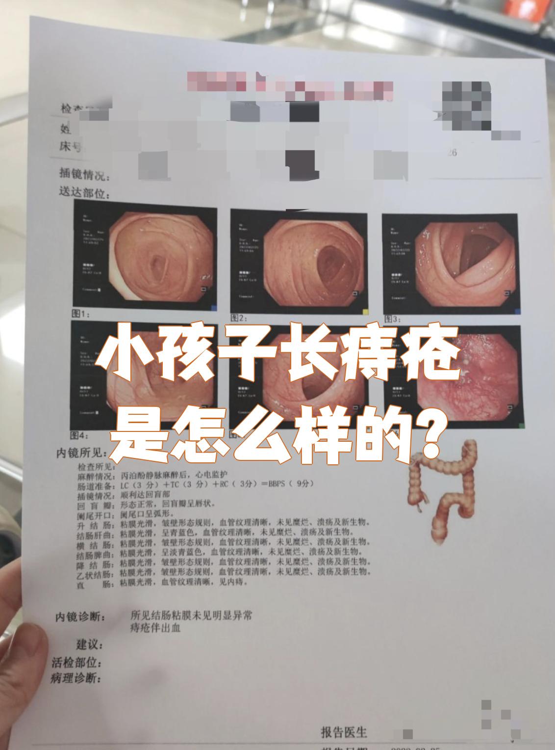 小孩子得痔疮时,最常见的表现是肛周肿块,排便出血和肛周疼痛