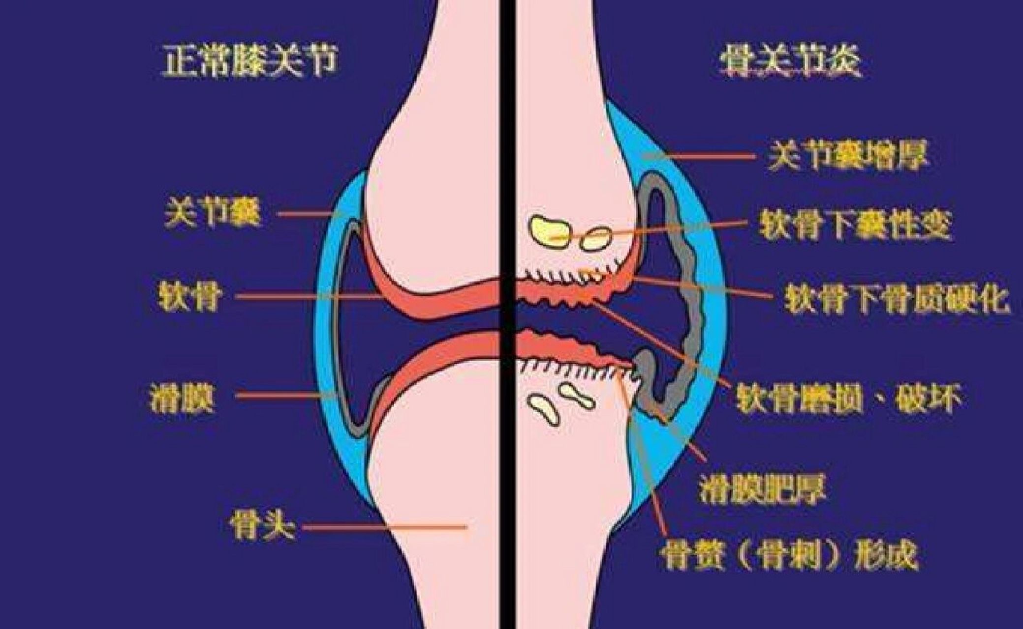 关节软骨的位置图片