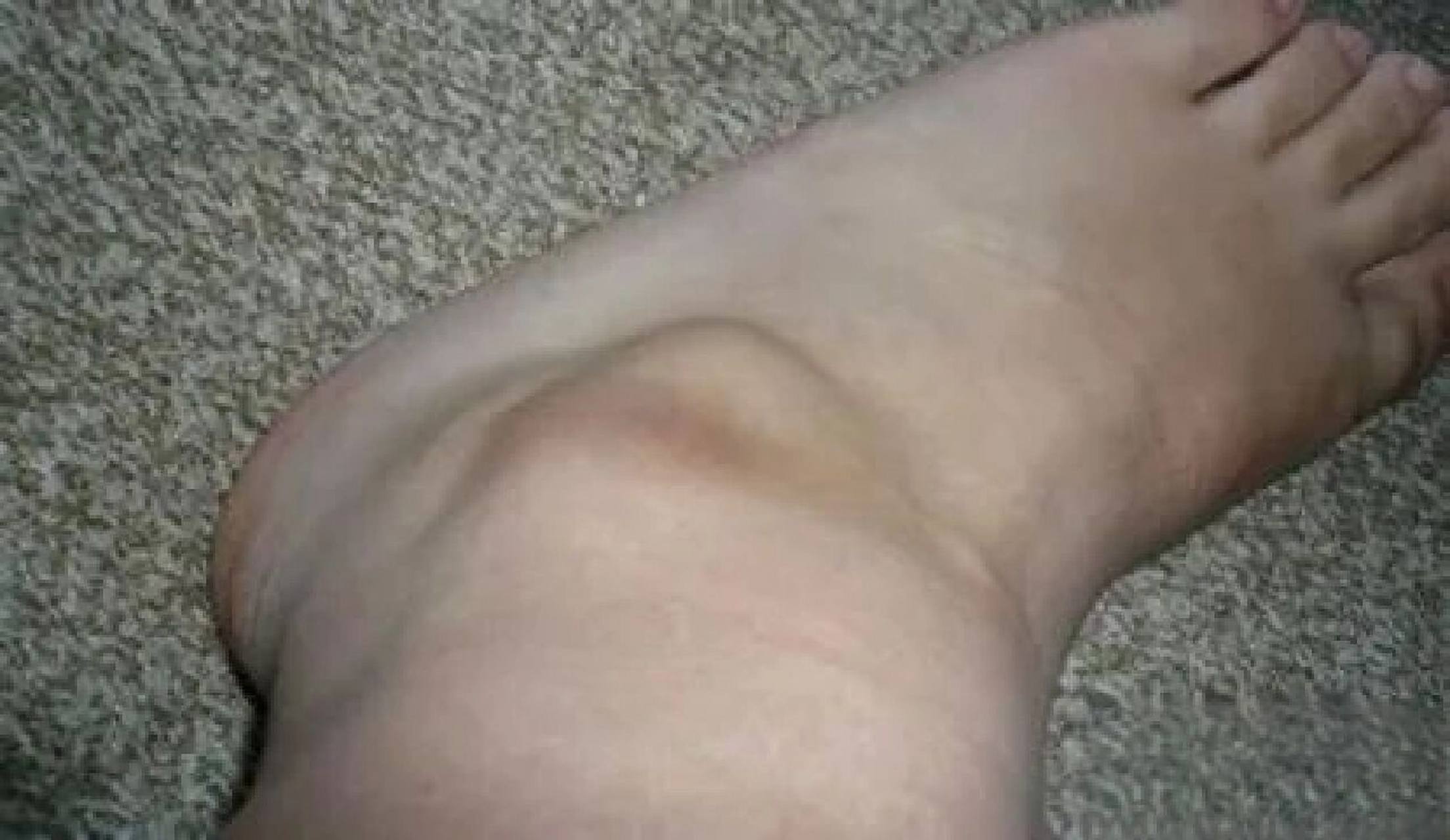 当心腱鞘囊肿 一,足踝部共有8个腱鞘:前方3个(胫前肌腱,拇长伸肌腱和