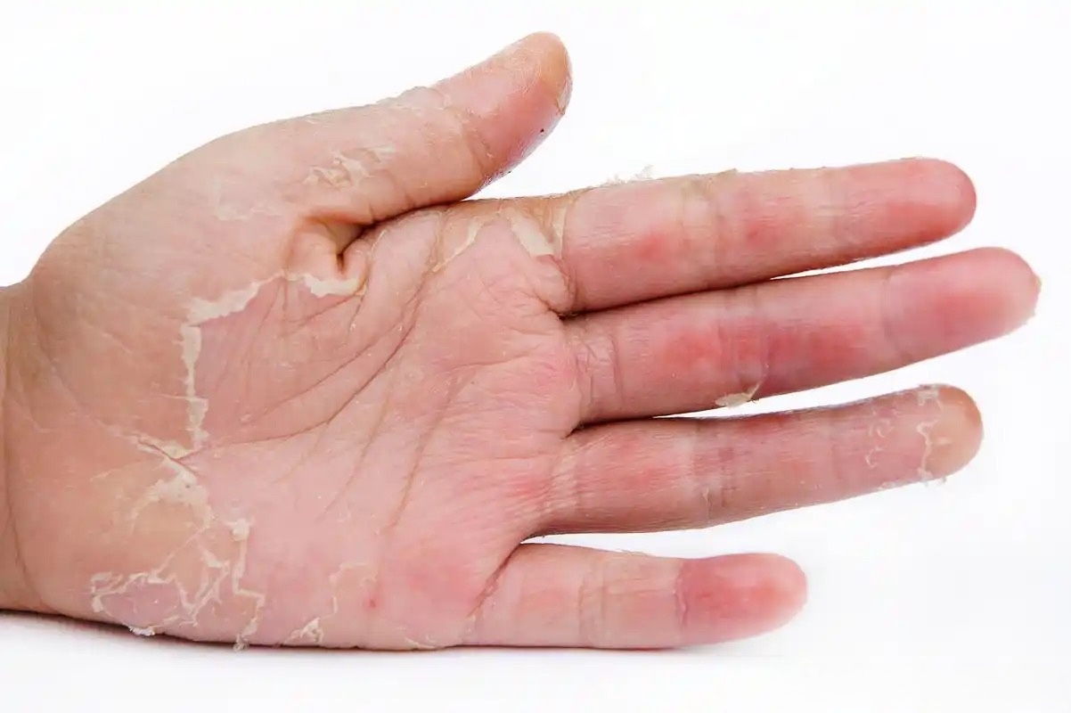 让她健康##手掌反复脱皮可能是这种病##女性健康必修课#