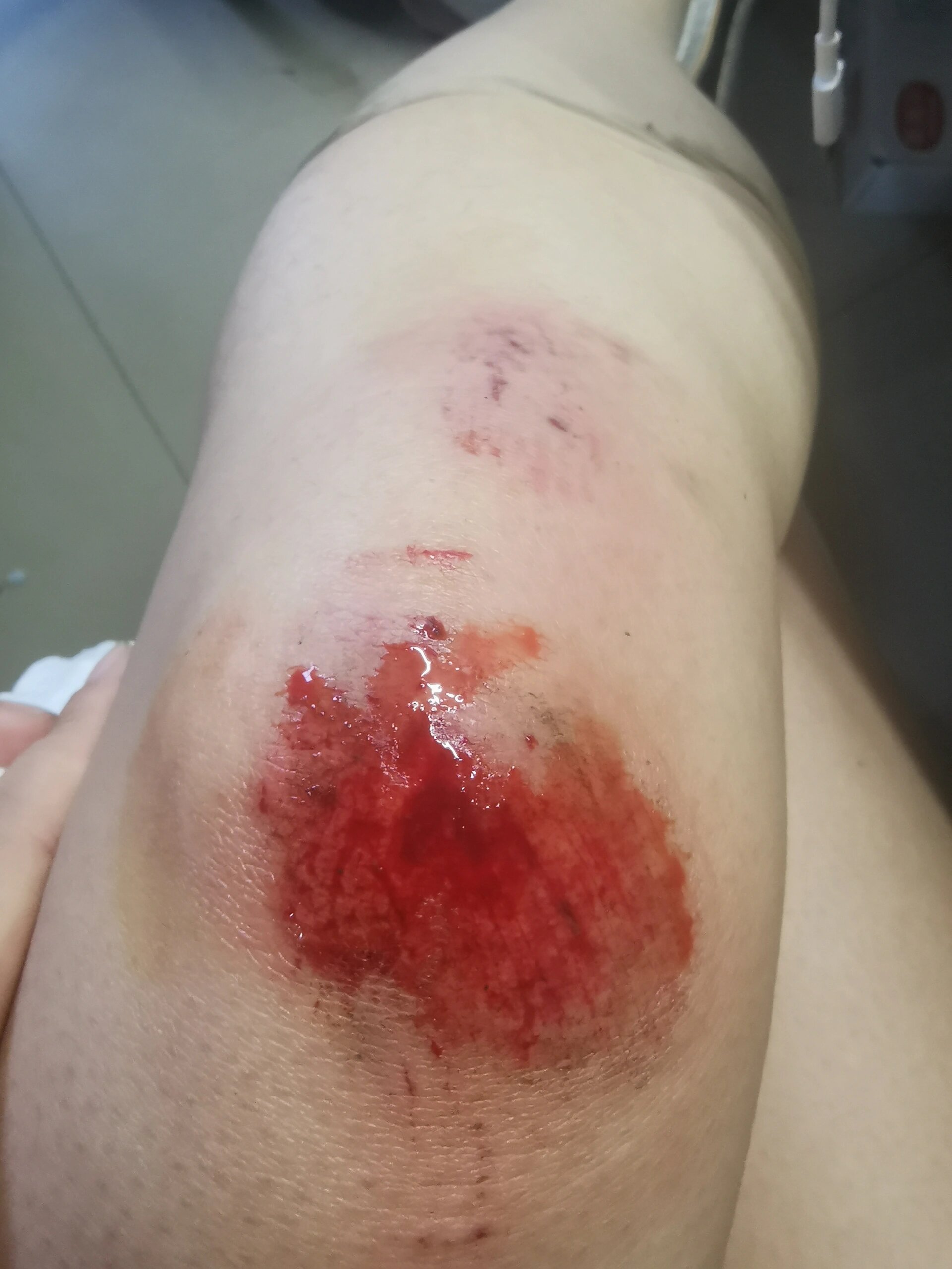 骑电动车膝盖摔伤第6天😭慎点