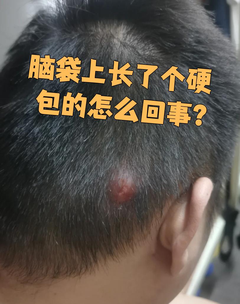 脑袋上长硬包常见的原因有脂肪瘤,皮脂腺囊肿和毛囊炎