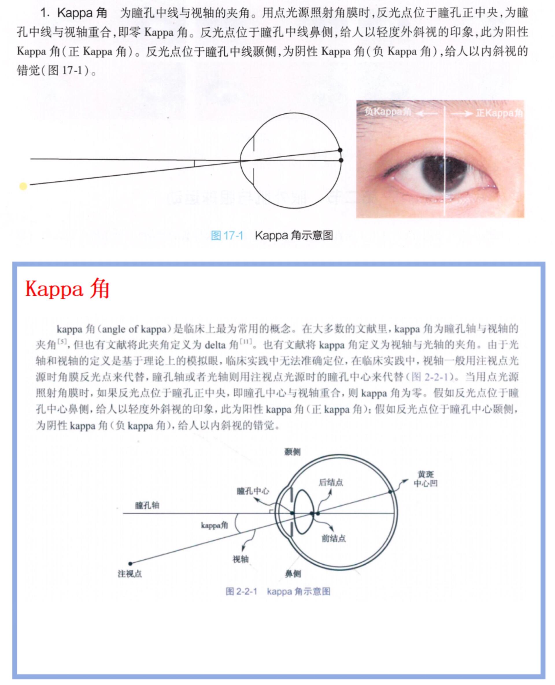 角膜地形图上看kappa角图片