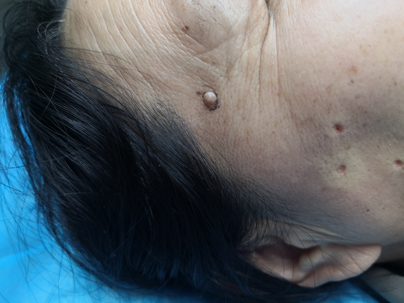 解决皮肤问题专注皮肤美容##色素痣