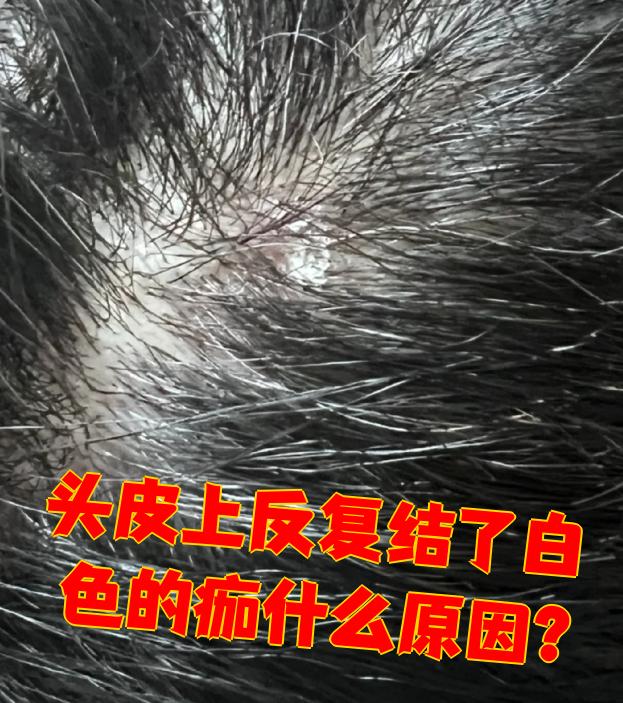 头皮上反复出现白色结痂,可能由多种原因引起,需根据具体情况进行