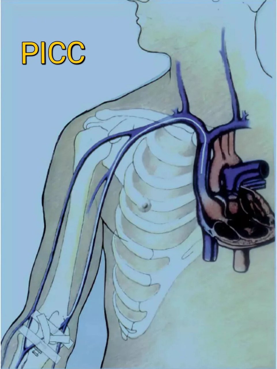 picc置管术是现在临床化疗病人中很常见的一种安全有效的置管技术在 