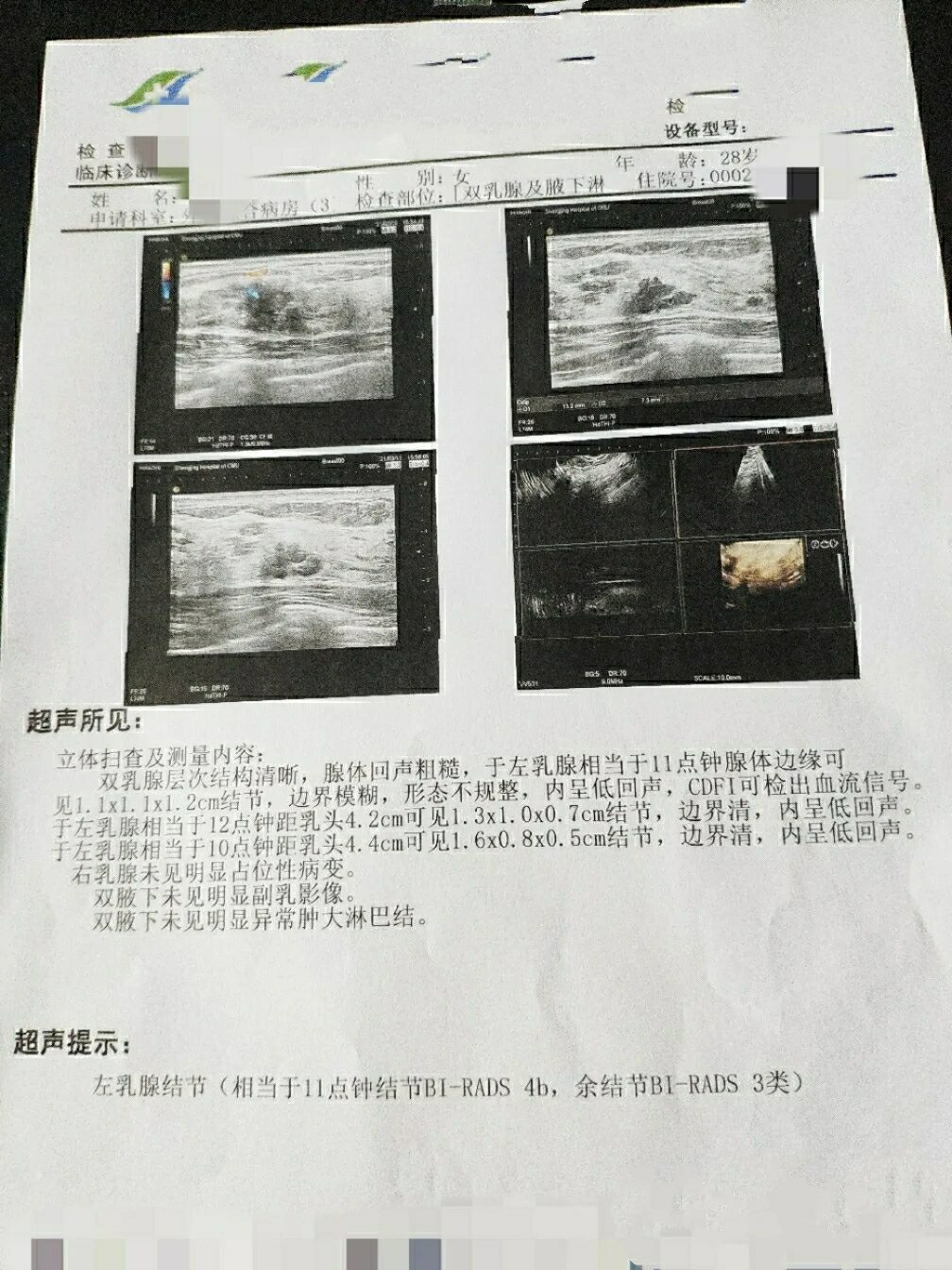 乳腺结节4c图片