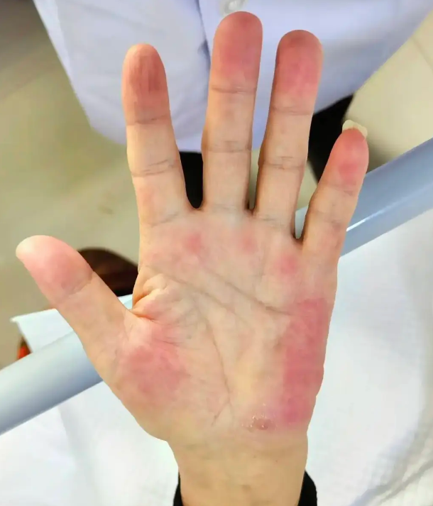 当肝功能异常时,血清胆红素浓度升高,就会导致皮肤和黏膜发黄