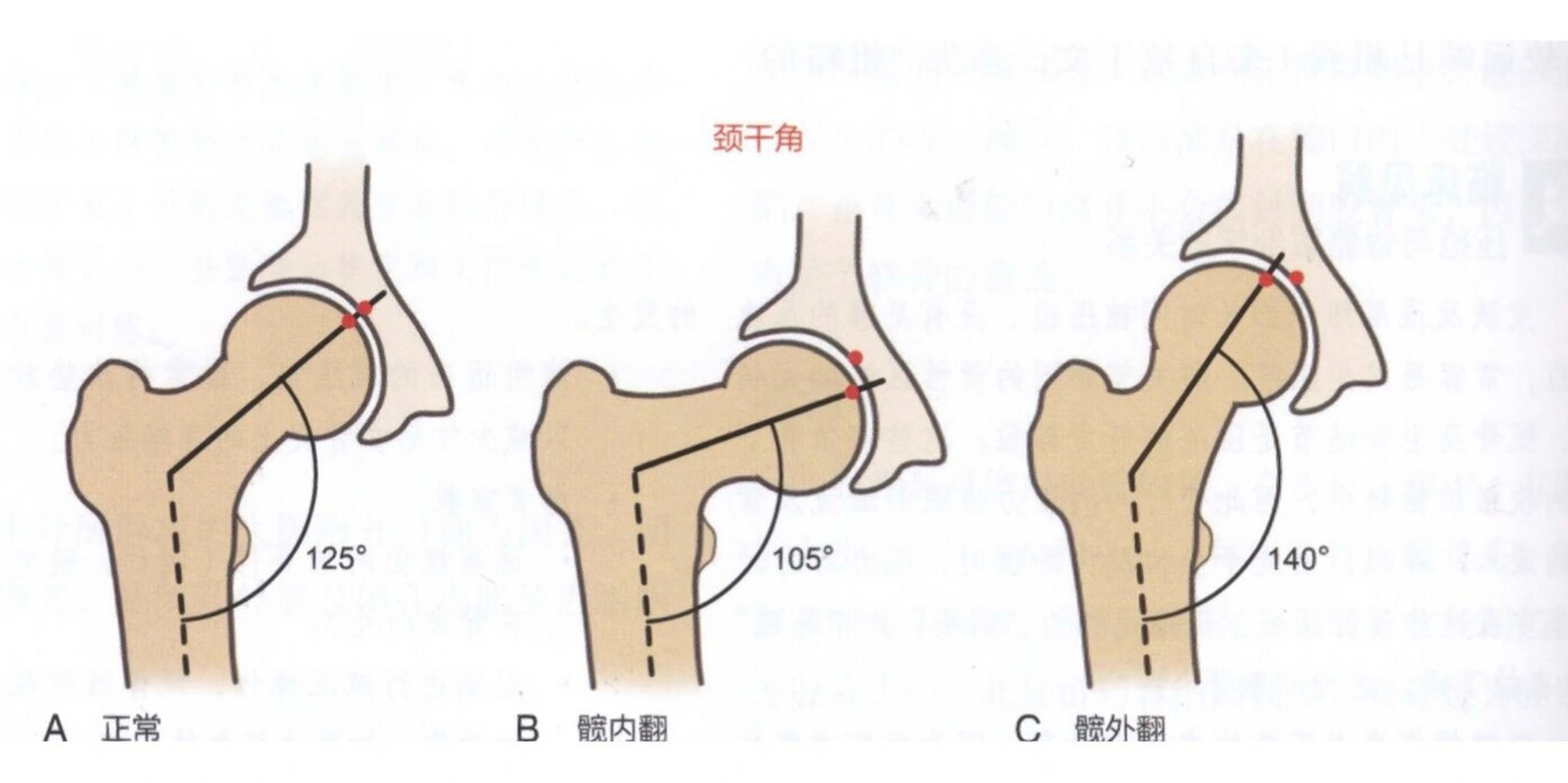 康复考研每日一题～颈干角和前倾角 今天的每日一题 今天是23年康理
