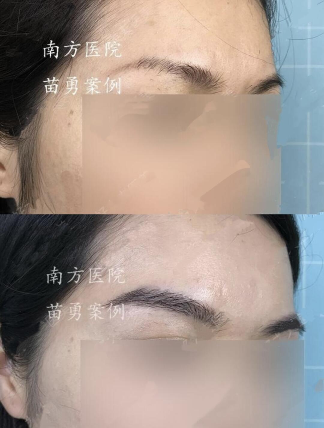 给予其充分沟通后实行双侧眉毛种植,术后效果自然逼真,非常满意