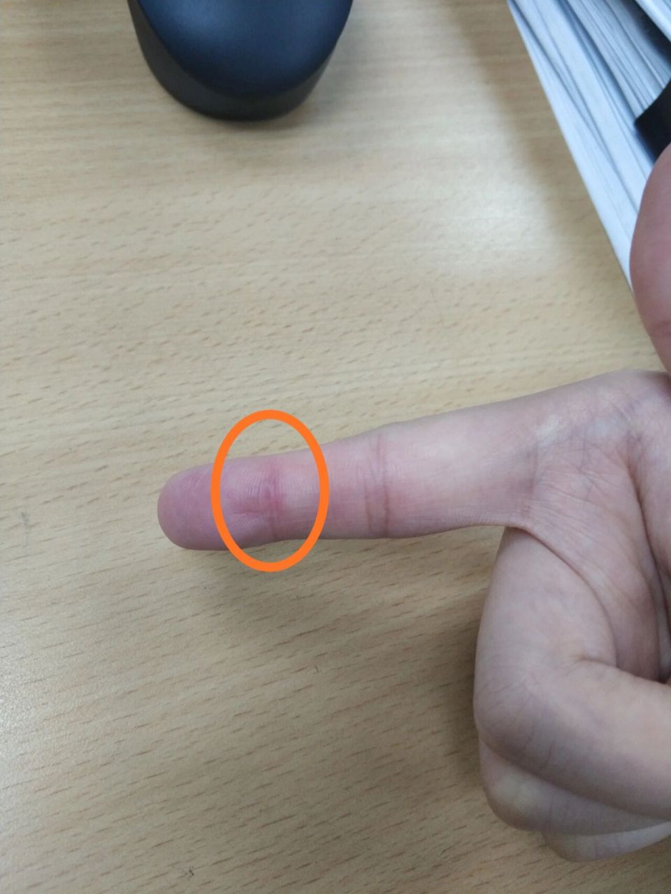 有宝宝知道食指肚这里有疙瘩是怎么了?