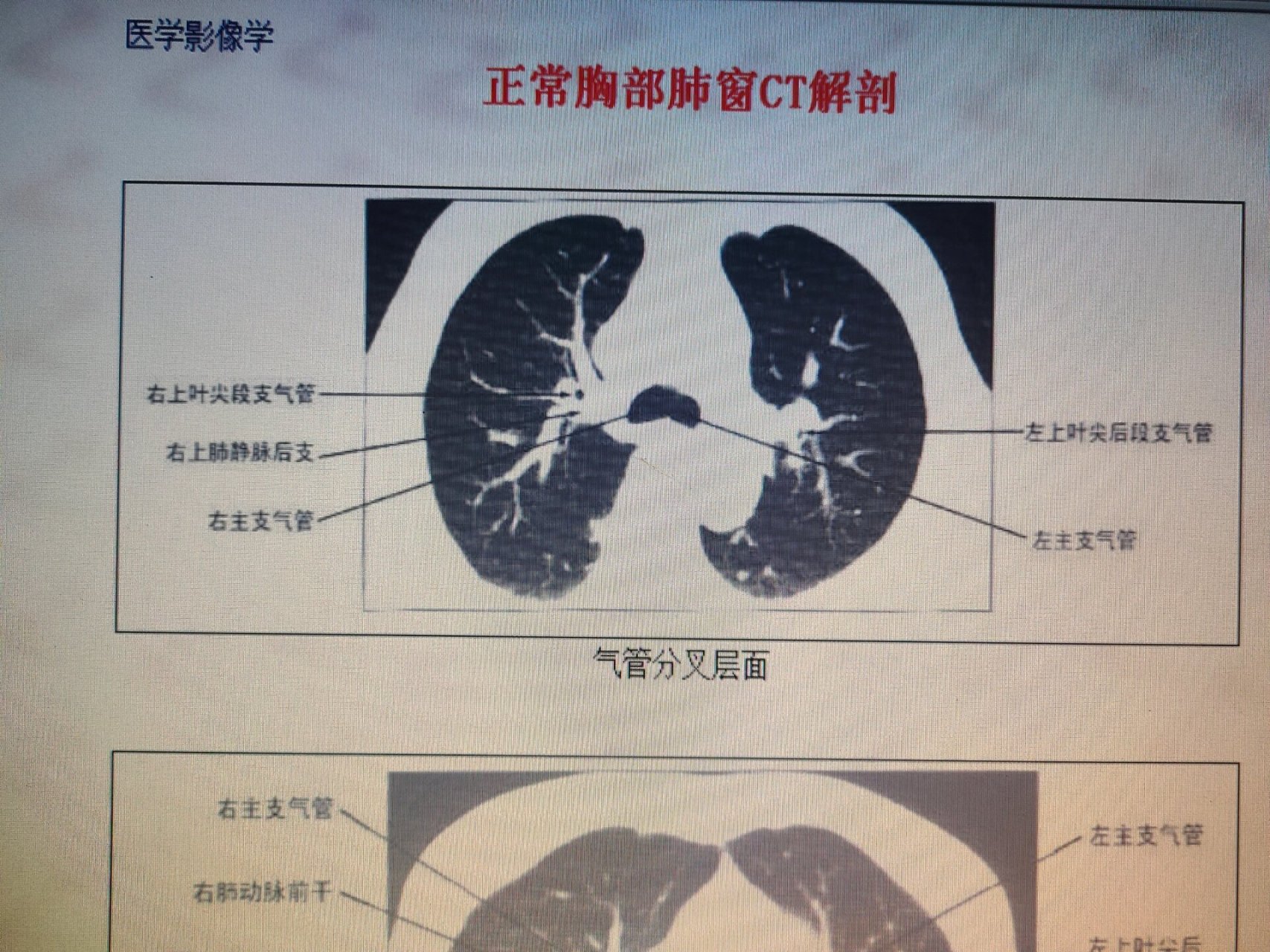 肺部正常ct图片图片