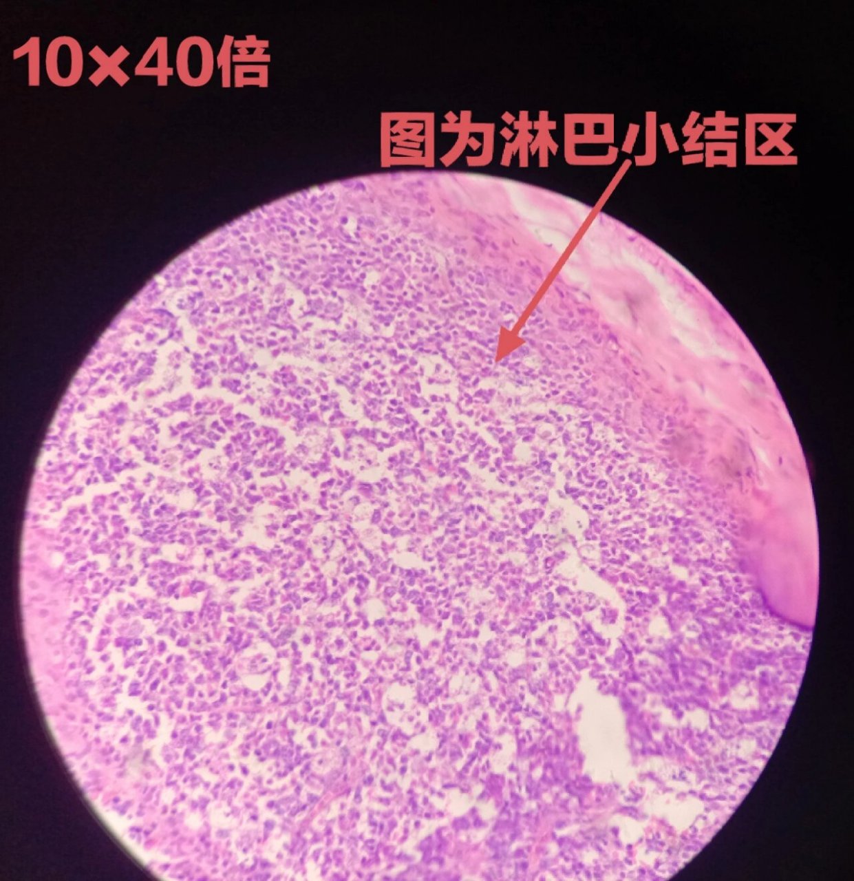 阑尾炎病理生理图图片