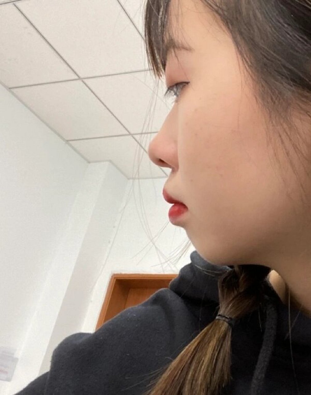 戴牙套1年脸型的变化7515 戴牙套前从来不知道自己的侧脸这么离谱