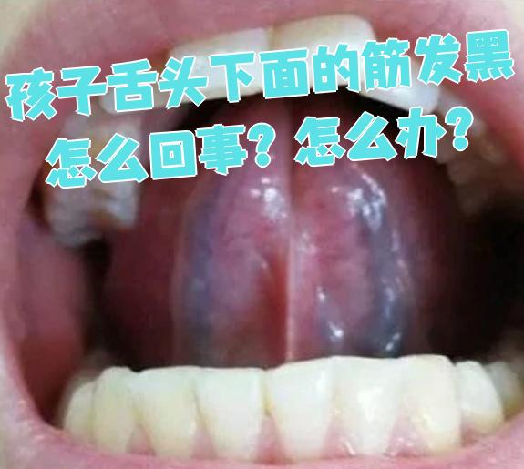 孩子舌头下面的筋发黑可能有几种原因,包括黏膜过薄,细菌感染或衍管