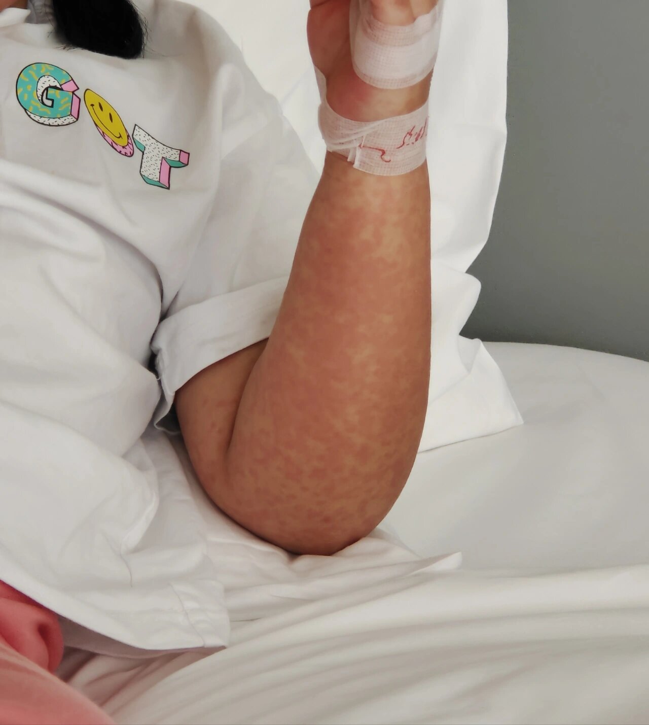 于是加了拉莫三嗪,9月21日第一次发烧,烧了4天,轻微皮疹,血常规为病毒