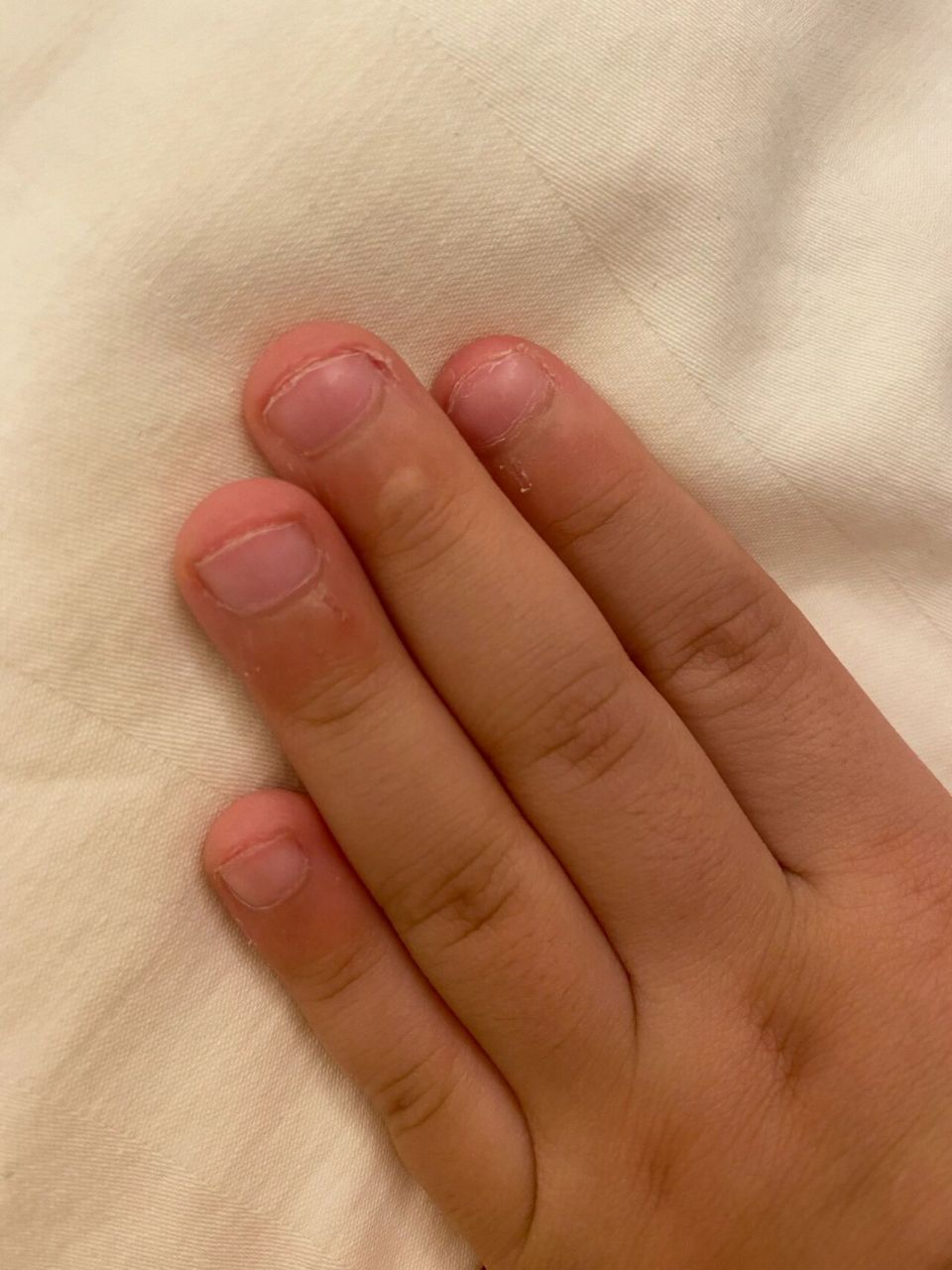 六岁的小朋友喜欢抠手指甲 不知道是因为焦虑 无聊 缺微量元素?