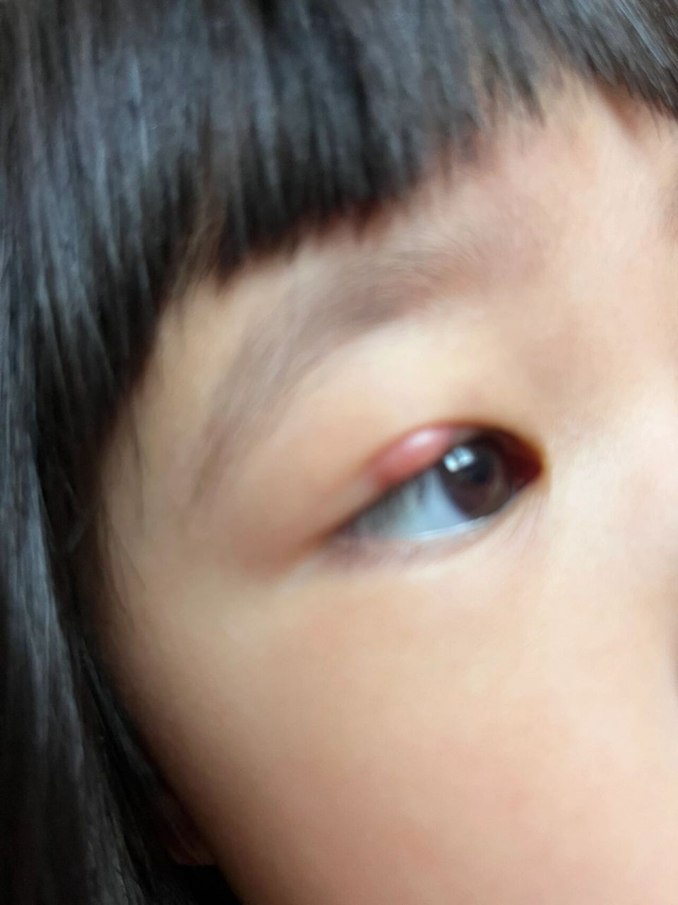 儿童霰粒肿 我的宝宝2岁多眼睛长了大包 前几个月 孩子眼睛大包不经意