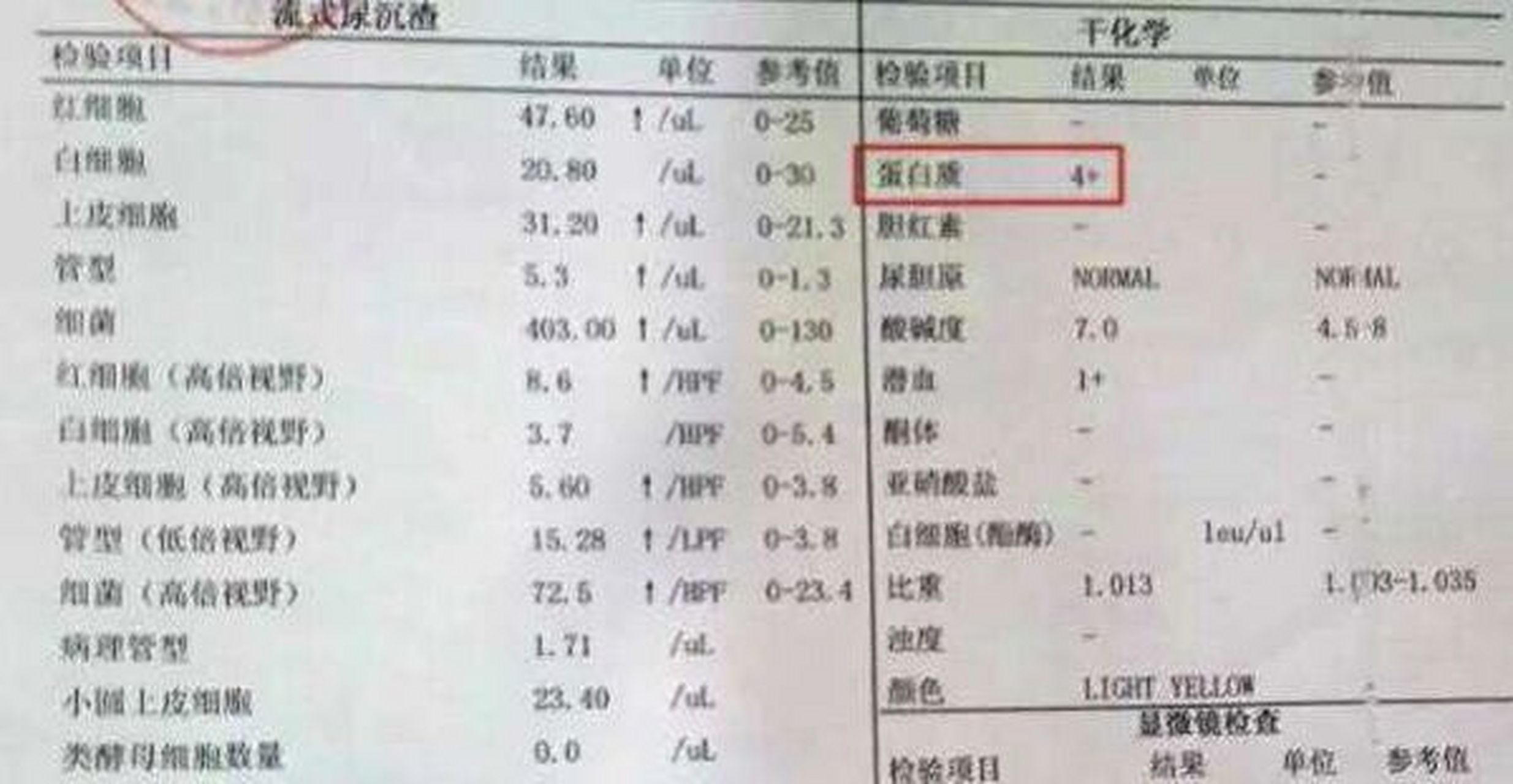 引起尿蛋白高的原因并不一定是疾病.那么尿蛋白高是怎么回事呢?