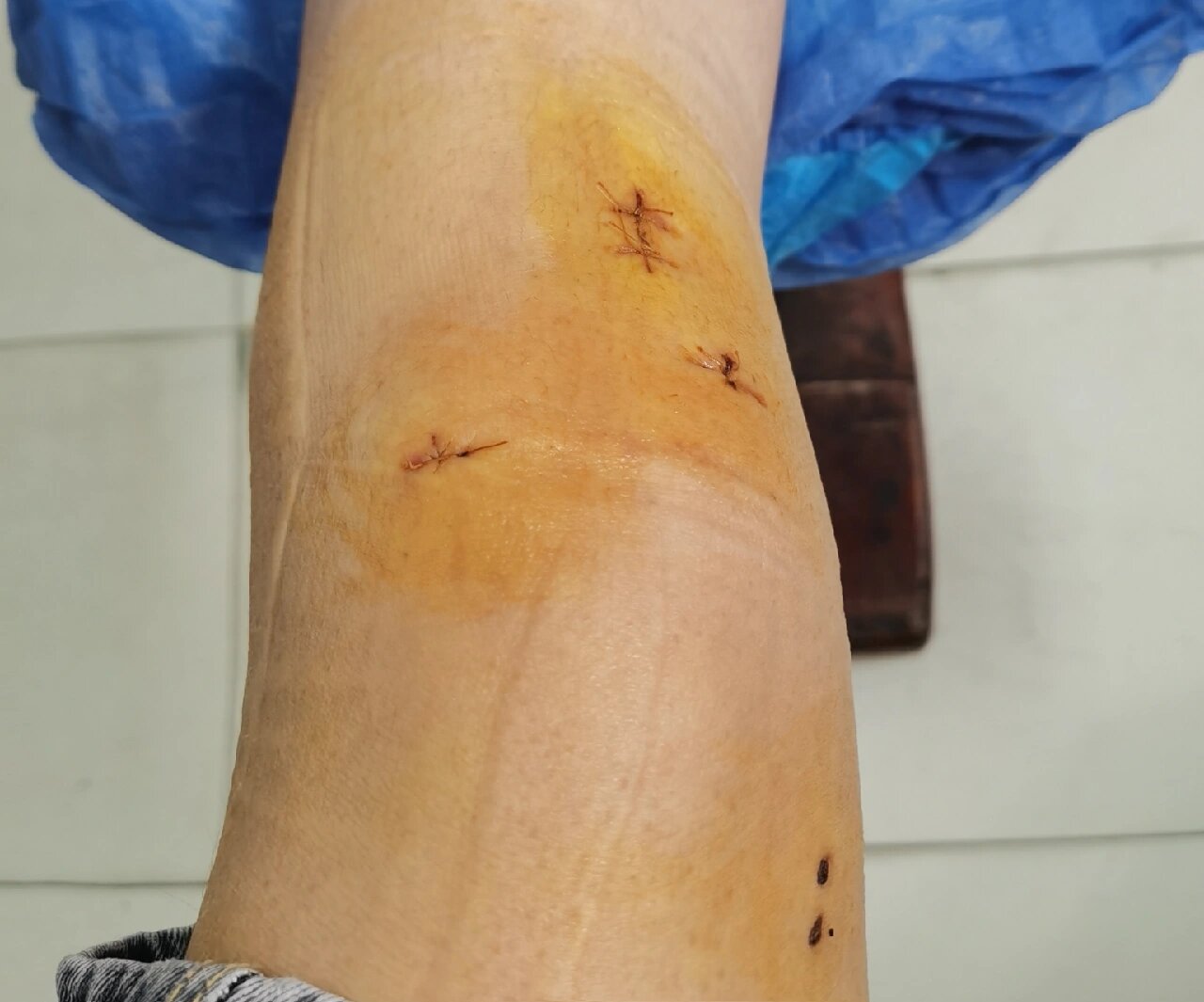 拆线日,前叉术后14天