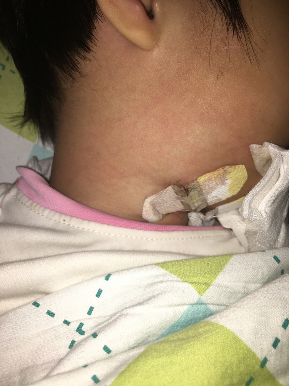 最勇敢的宝贝 3岁86615个月,甲状舌骨囊肿,经历了3个小时的手术