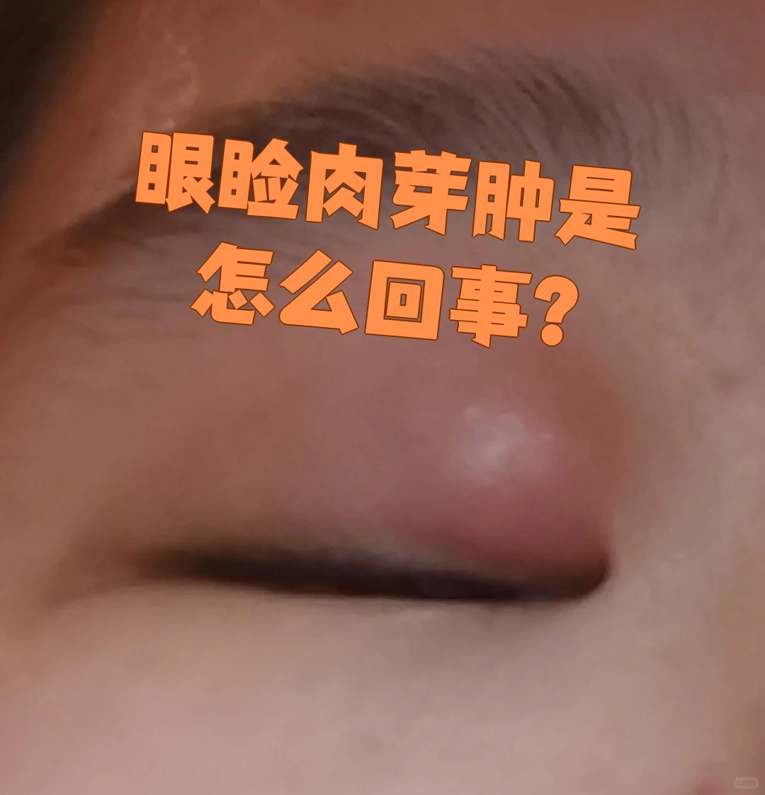 眼睑肉芽肿通常是因为麦粒肿或霰粒肿没有及时治疗,炎症刺激组织