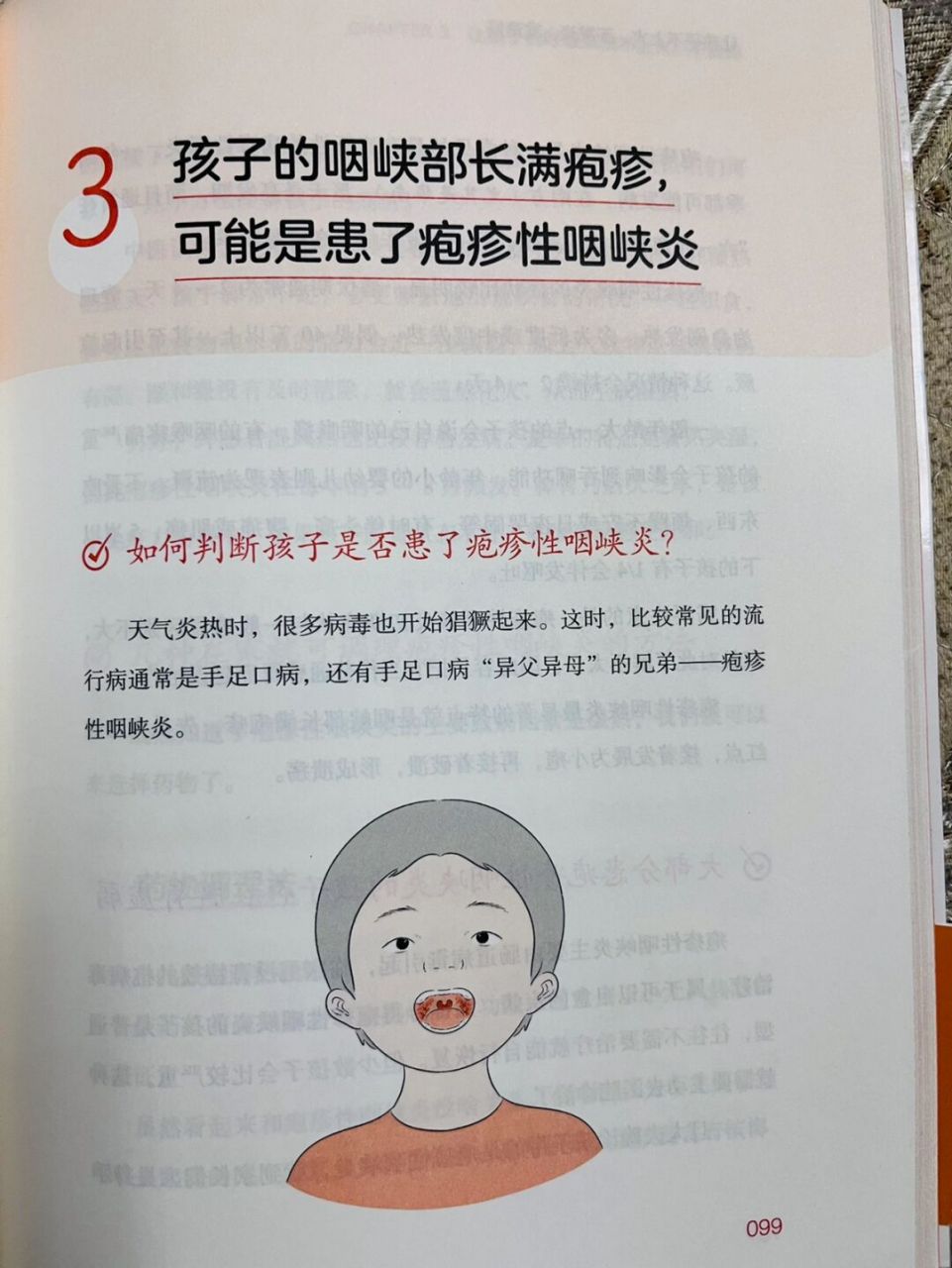 怎样判定小孩有咽峡炎图片