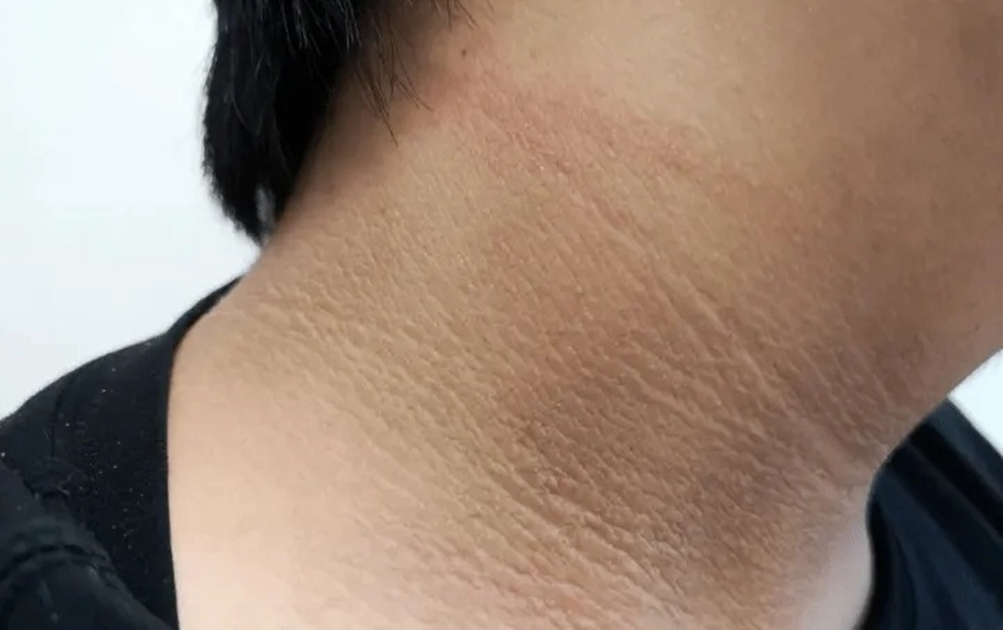 【脖子黑的人建议查查血糖】脖子上出现类似污垢的"泥",是一种皮肤病