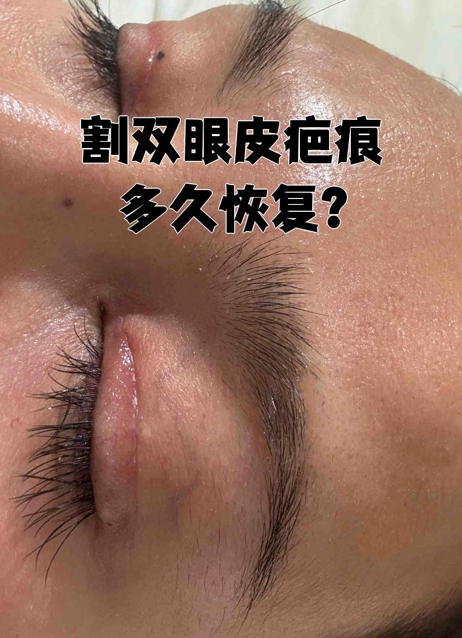 常见的双眼皮手术包括双眼皮埋线术和全切双眼皮,这两种方式都可能