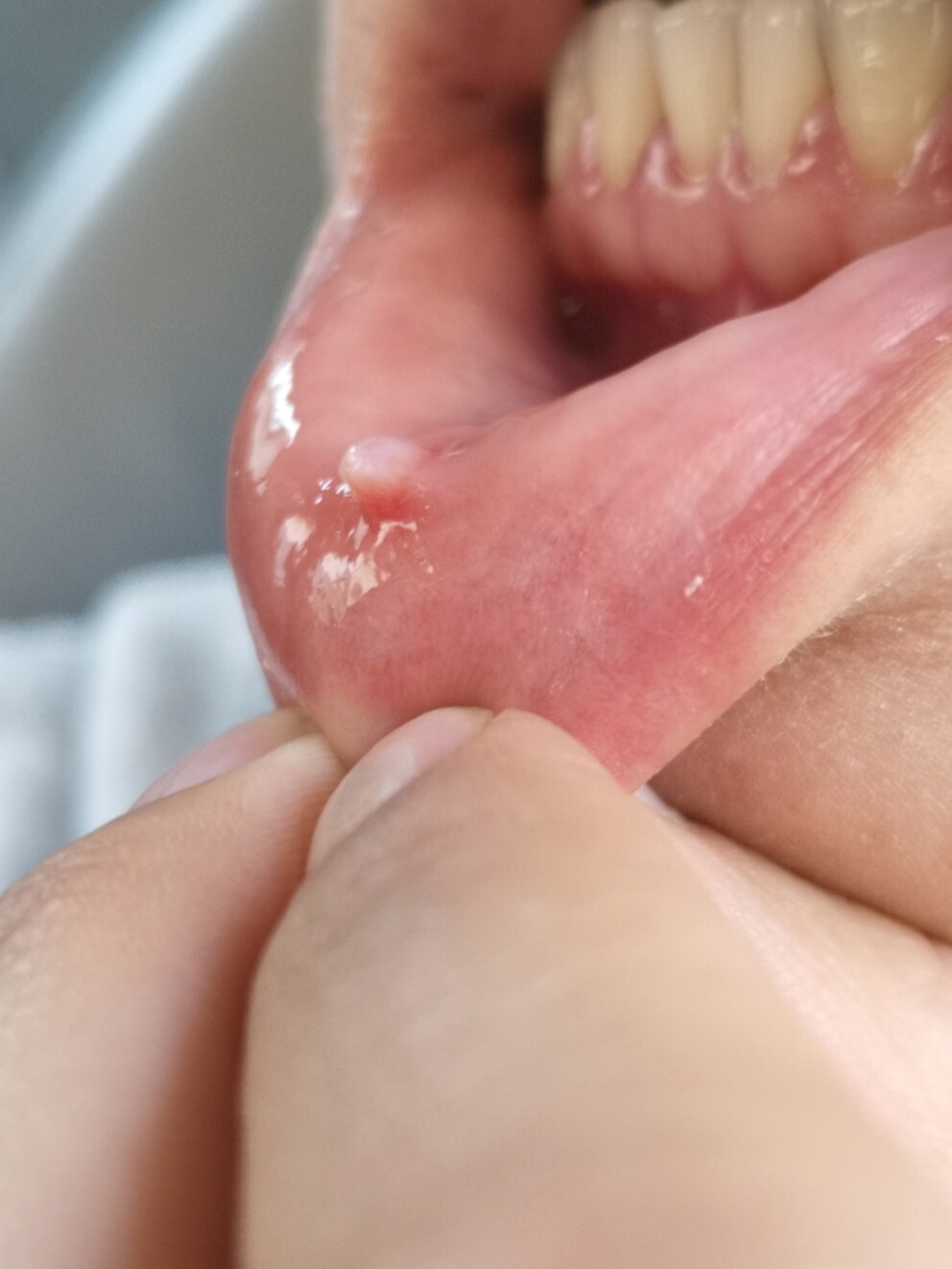 粘液腺囊肿 使用碘酊华素片