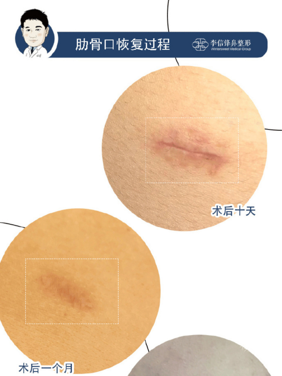 肋软骨隆鼻,取肋疤痕问题, 有创口则必定会有疤痕,只不过是痕迹深与浅