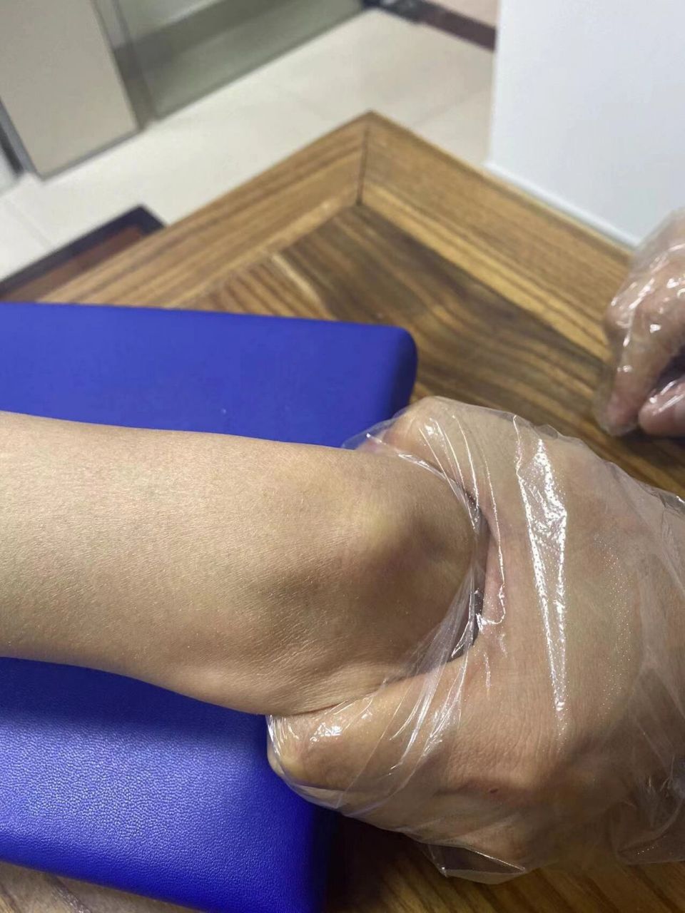 腱鞘囊肿,一次治疗痊愈