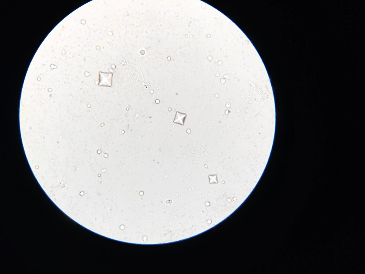 尿常规:草酸钙结晶,临床意义:多了容易肾结石