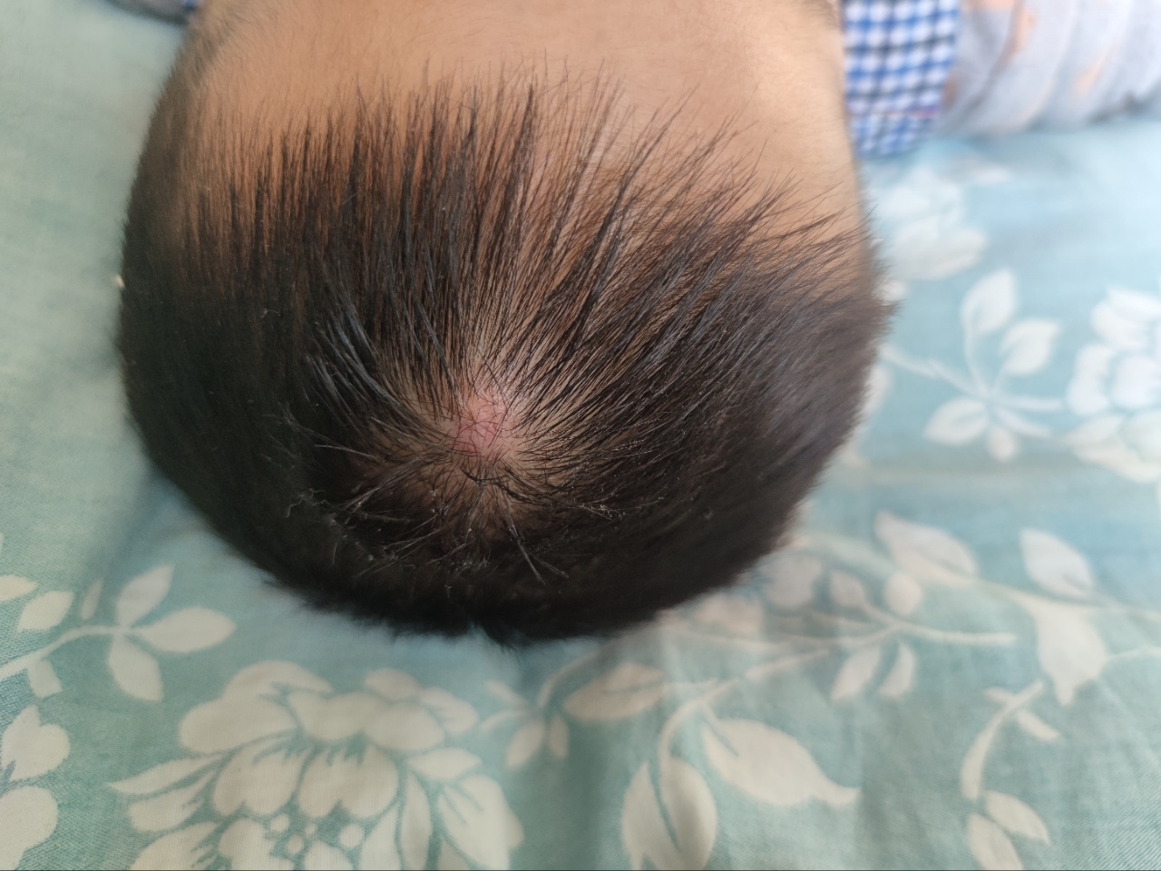 宝宝头上长红疙瘩 宝宝头上长了红疙瘩 也不知道是什么,之前一直以为