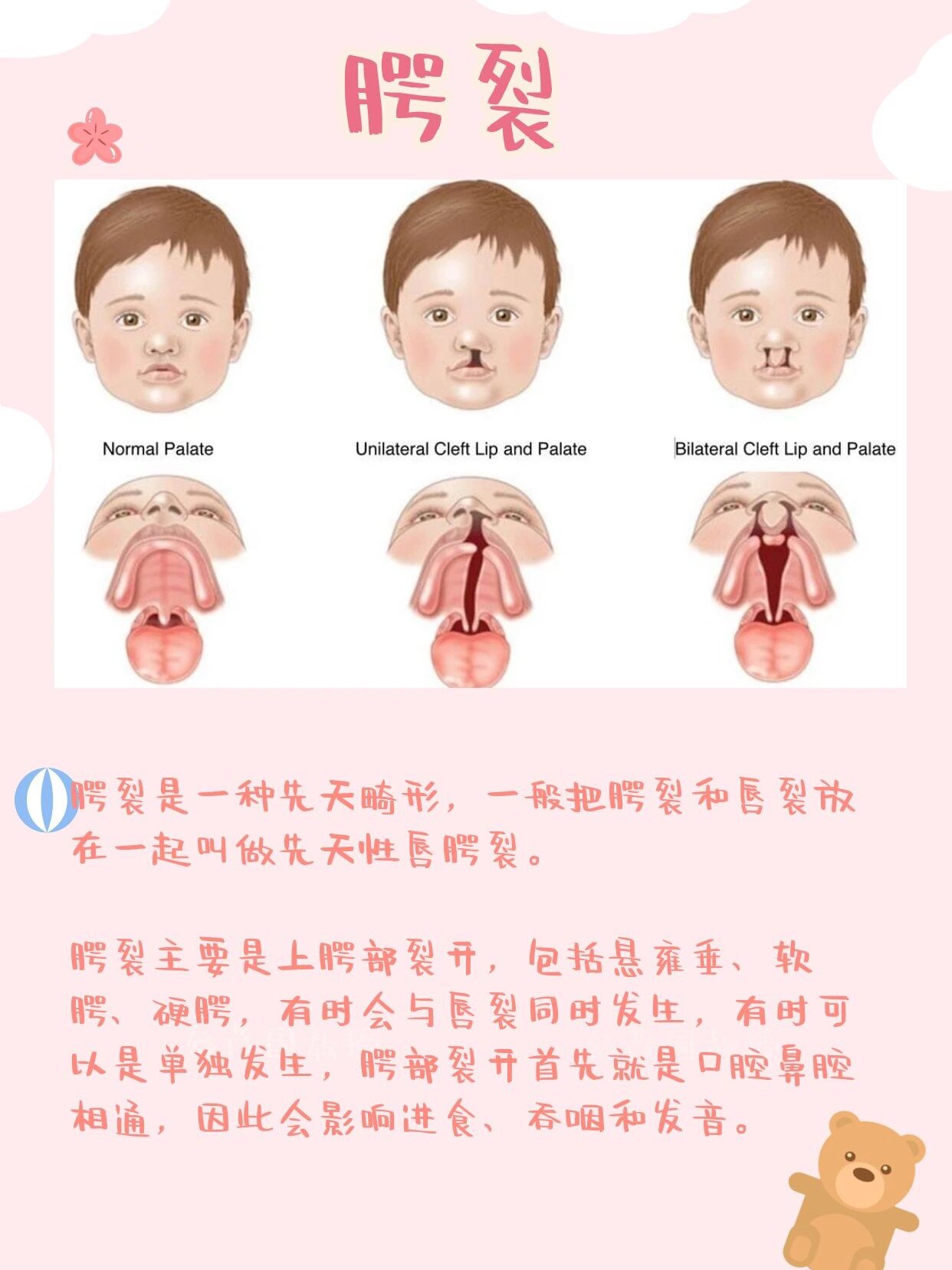 三度唇腭裂图片图片