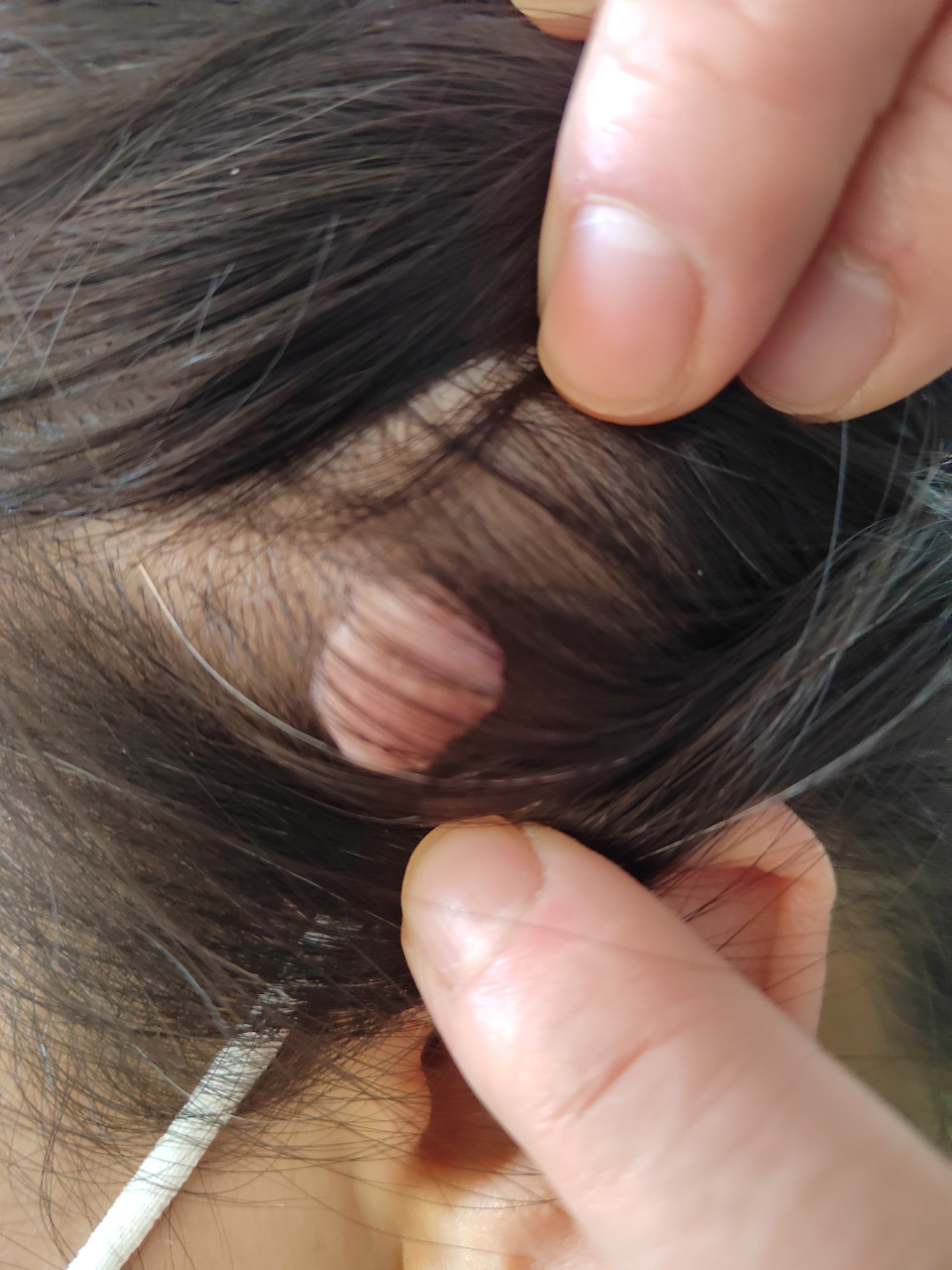 质软.考虑色素痣.可以手术切除活检诊断一下确定.#色素痣##美容