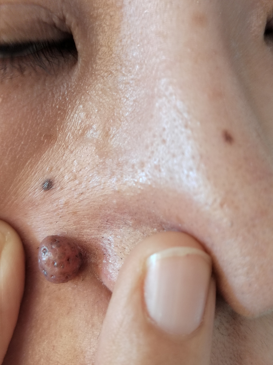 激光治疗色素痣后五天图片.