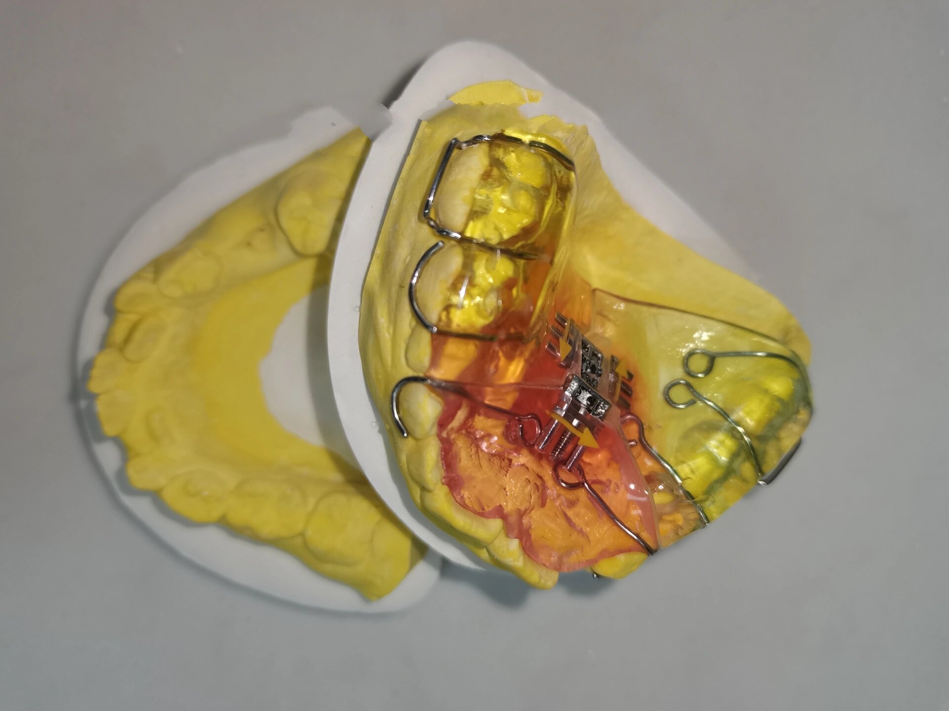 牙弓狭窄之——三向活动扩弓器6015