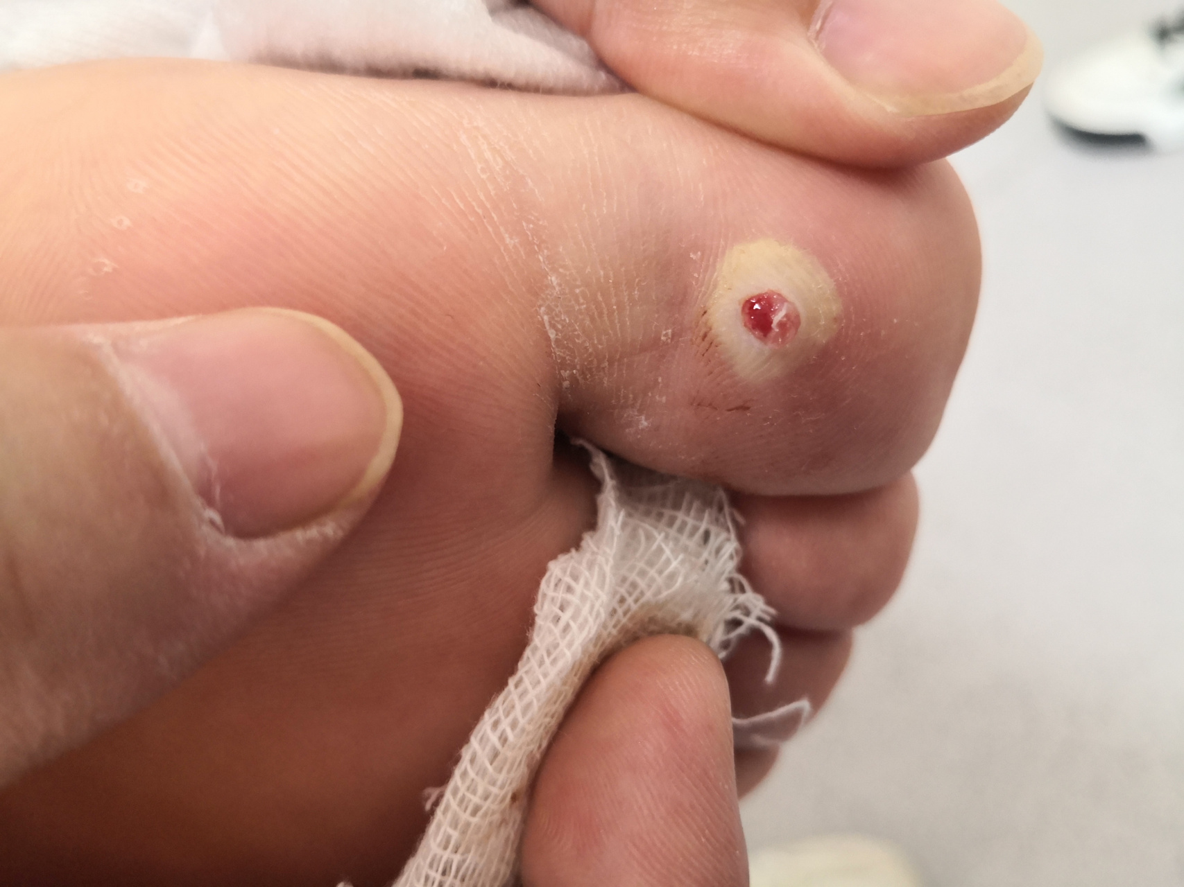 考虑化脓性肉芽肿#解决皮肤问题专注皮肤美容##肉芽肿