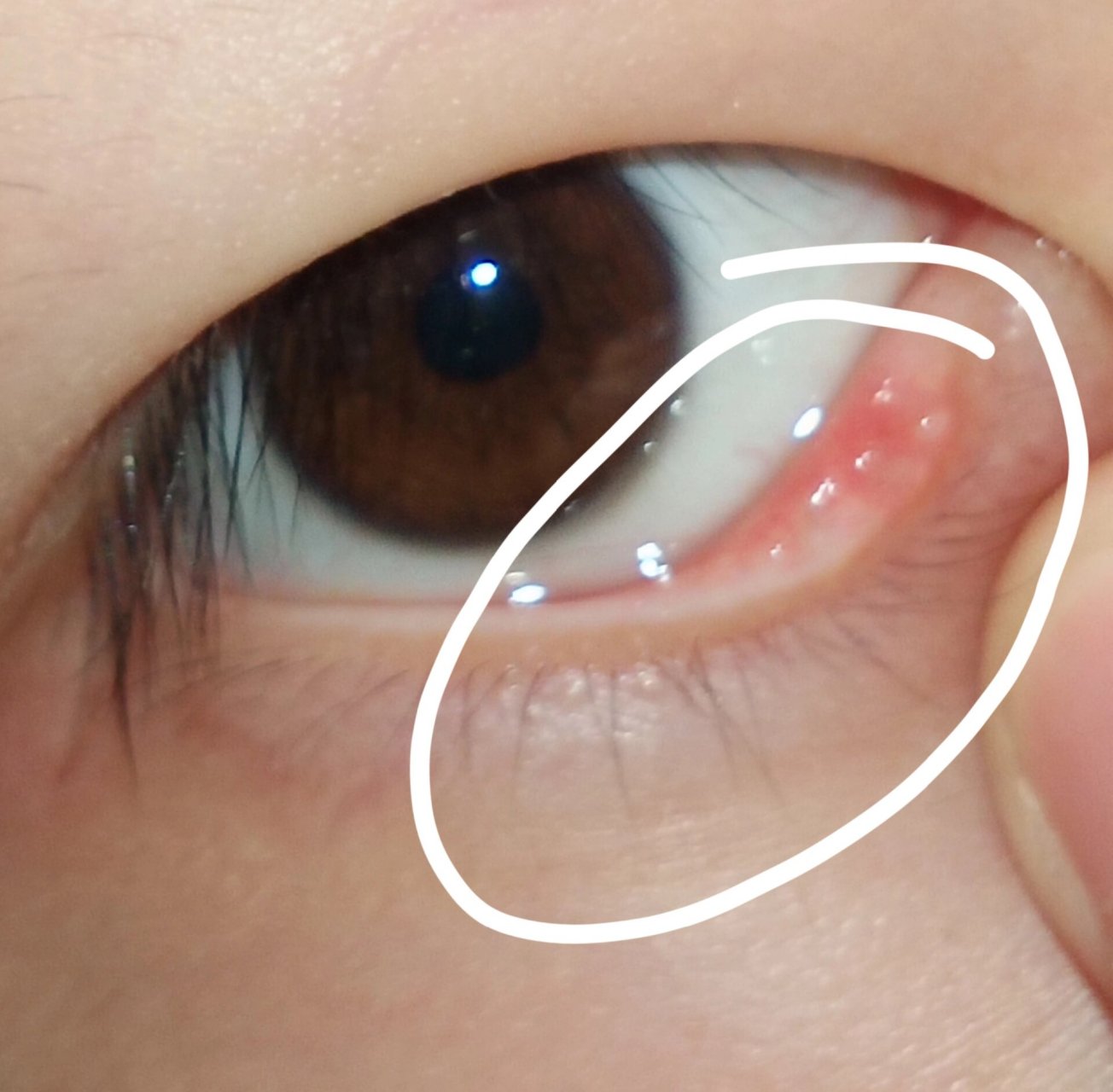 下眼角处长了几个小颗粒有没有事啊?