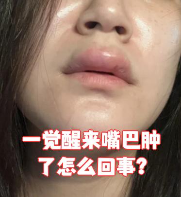 为什么嘴巴会肿