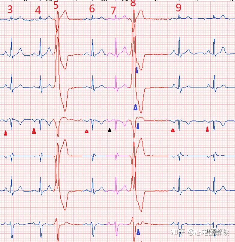 室性早搏房性早搏室房逆传