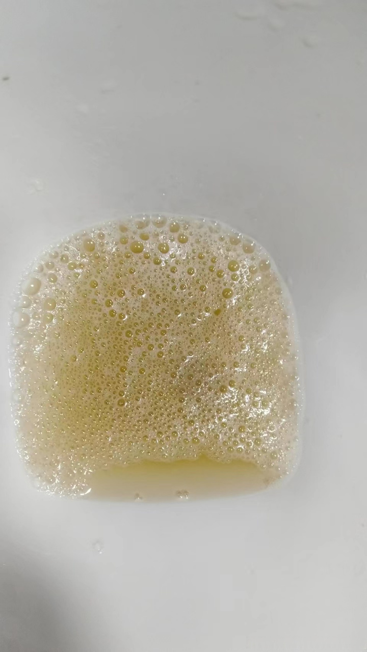 尿蛋白细小泡沫的图片图片