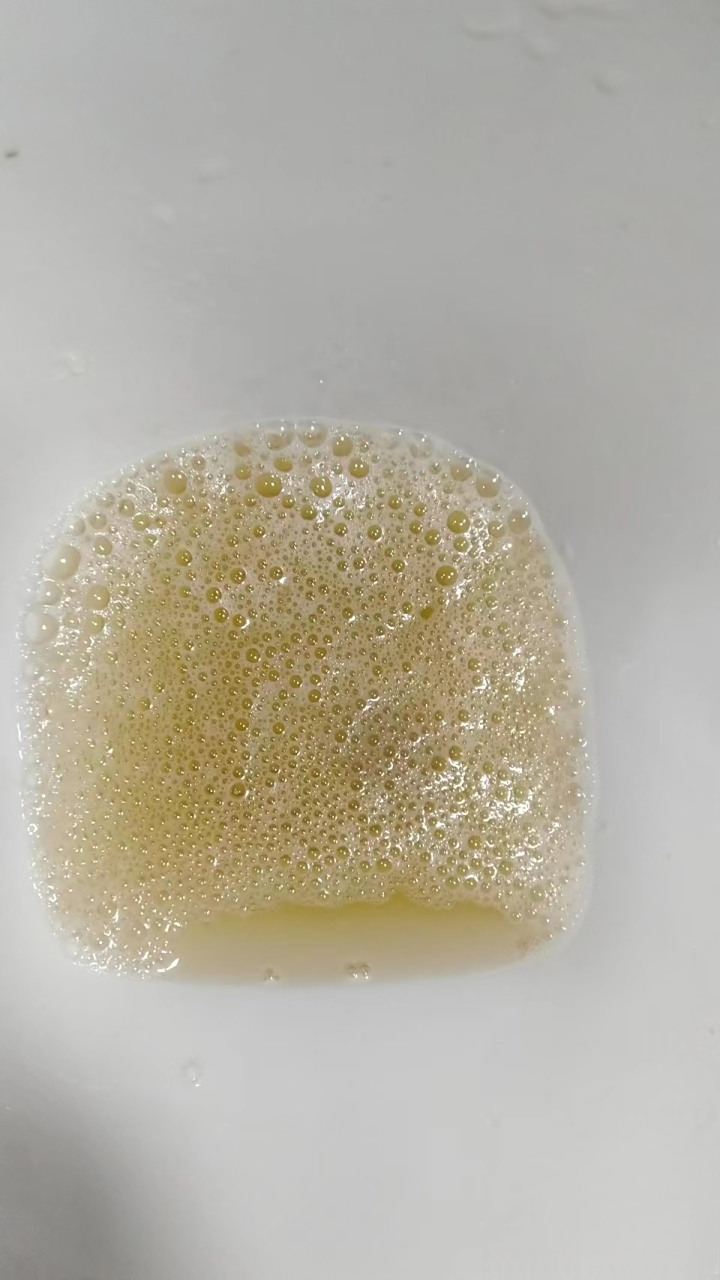 当时查尿蛋白2 ,红细胞3 ,24小时尿蛋白定量1.