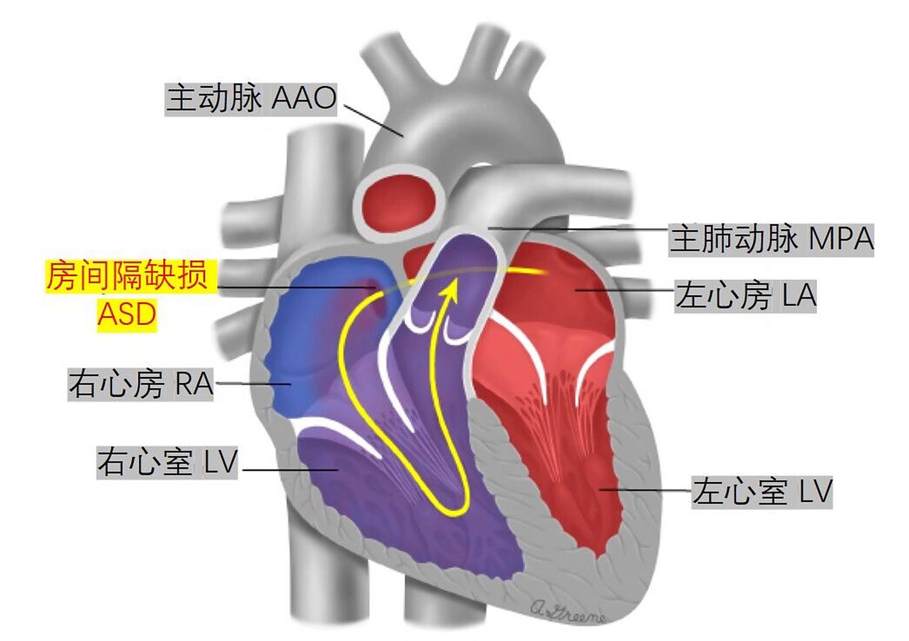 asd的临床结局与缺损的解剖位置,缺损大小及有无其他心脏异常相关.