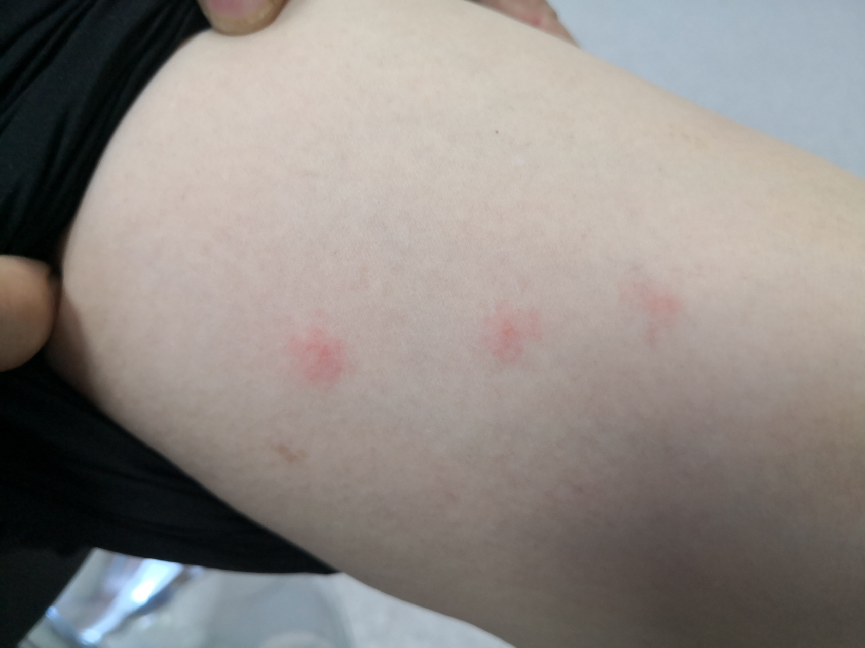 蚊虫叮咬导致的虫咬皮炎症状#解决皮肤问题专注皮肤美容##丘疹性荨