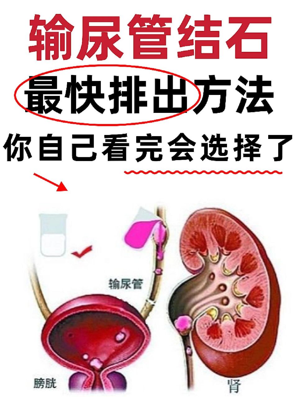 快排出输尿管结石的方法,你自己看完会选择 94输尿管结石就是长在输