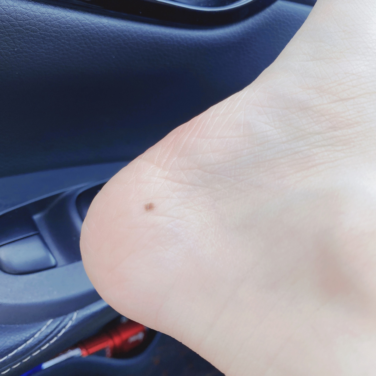 看到好多人说脚上的痣要去弄掉,看得怕怕的,去年长出来的,准备跟它say