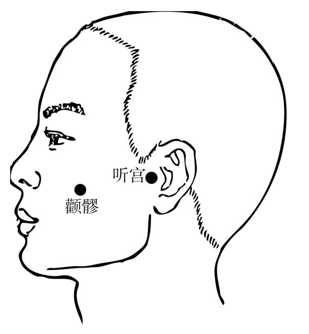 颧髎穴——三叉神经痛要穴 【位置】由目外眦直下,颧骨下缘的凹陷处