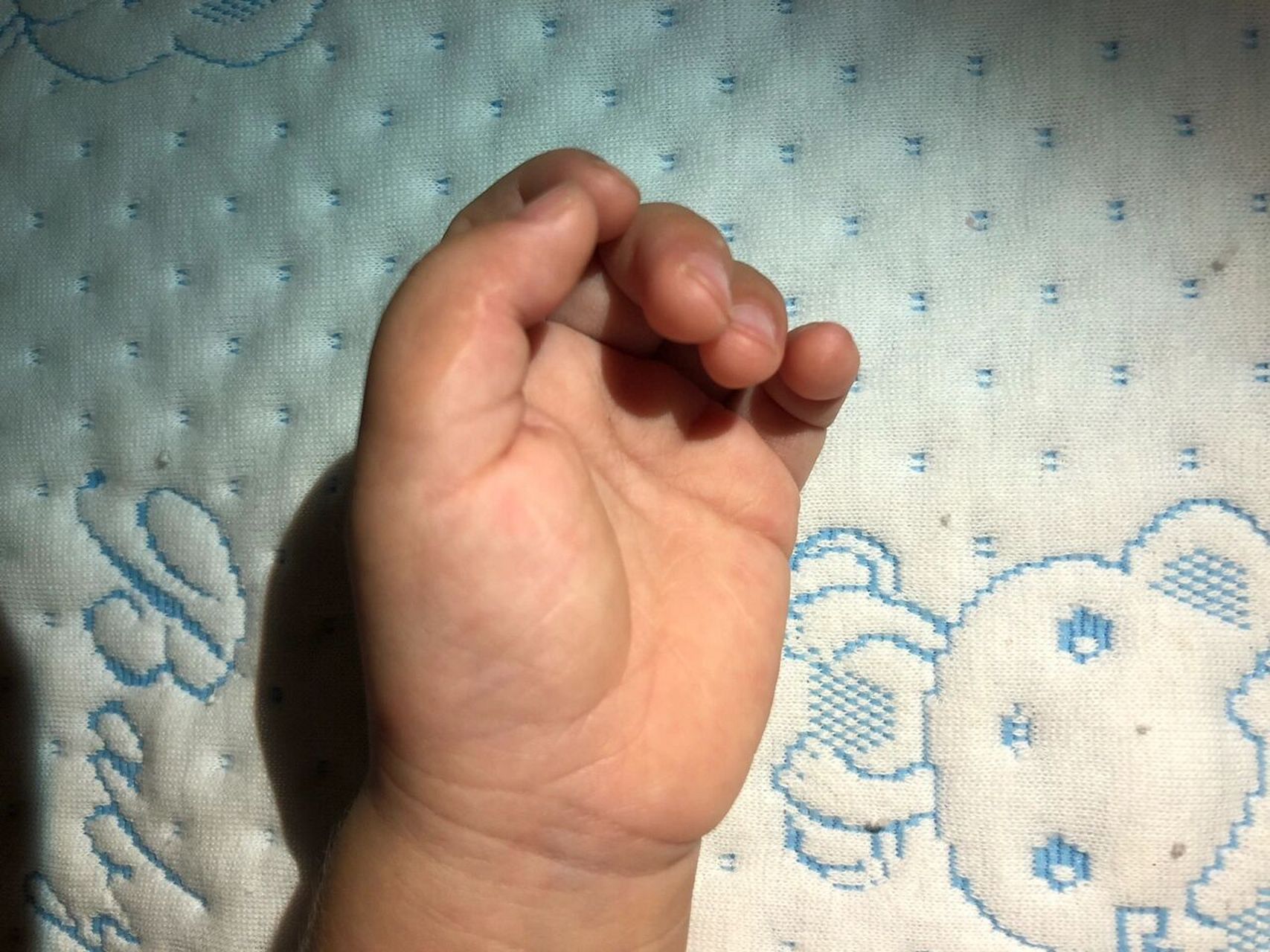 六指宝宝手术前和手术一年后对比照